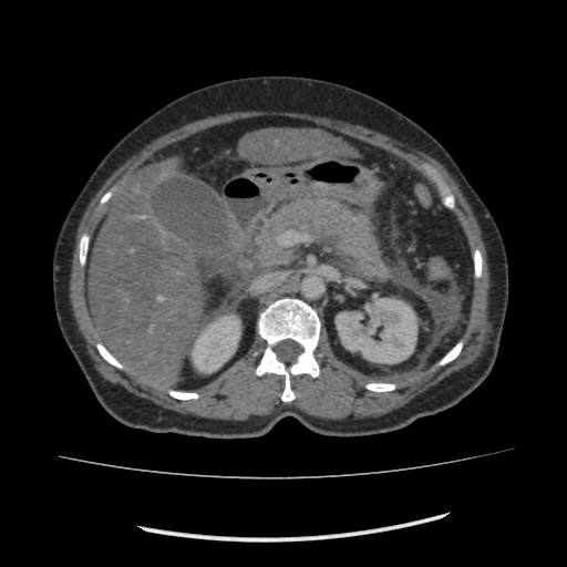 Acute pancreatitis (Radiopaedia 80007-93285 Axial C+ portal venous phase 58).jpg