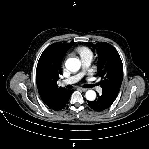 File:Acute pancreatitis (Radiopaedia 85146-100701 Axial C+ arterial phase 7).jpg