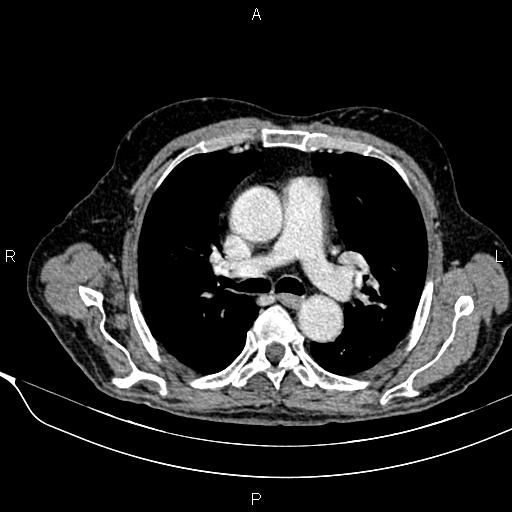 Acute pancreatitis (Radiopaedia 85146-100701 Axial C+ portal venous phase 2).jpg