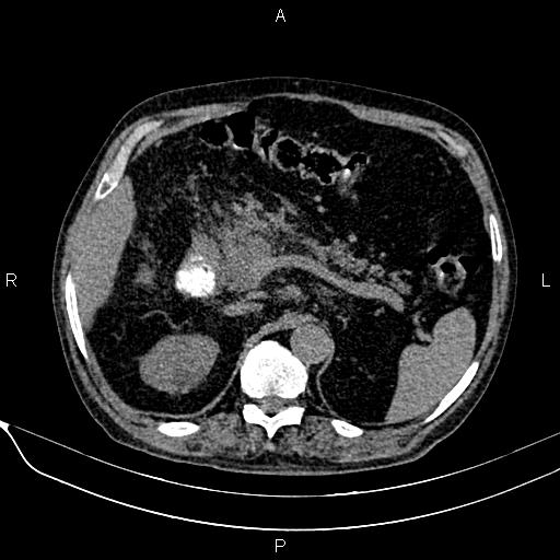 Acute pancreatitis (Radiopaedia 85146-100701 Axial non-contrast 41).jpg