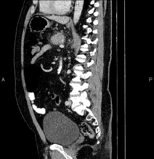 Acute pancreatitis (Radiopaedia 85390-101010 Sagittal C+ portal venous phase 59).jpg