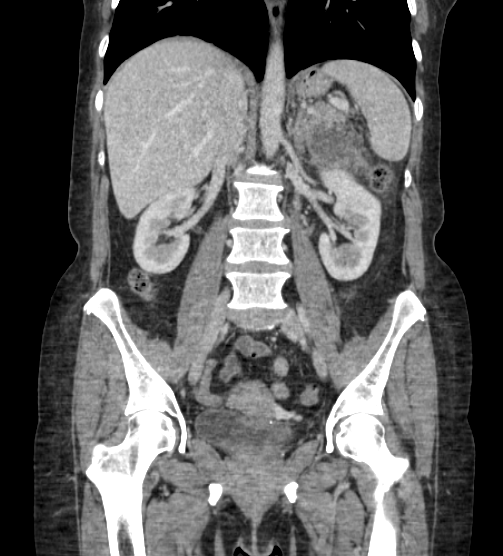 Acute pancreatitis - Balthazar E - post ERCP (Radiopaedia 27562-27772 Coronal C+ portal venous phase 48).png