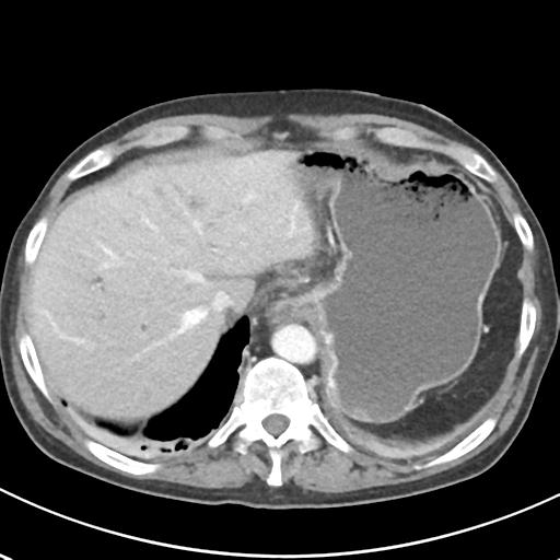 File:Acute pancreatitis and walled-off necrosis (Radiopaedia 29888-30404 Axial C+ portal venous phase 13).jpg