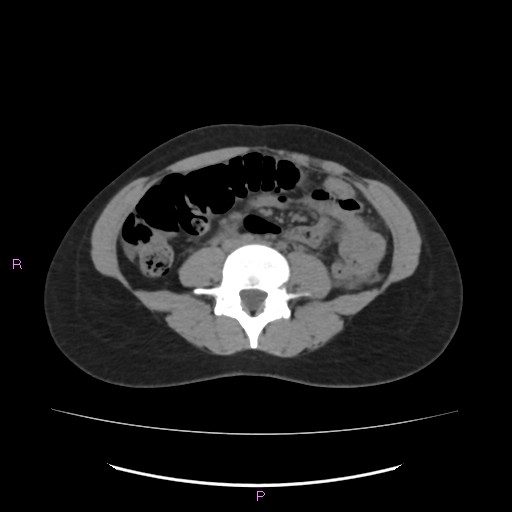 Acute pancreatitis secondary to stone at minor papilla and pancreatic divisum (Radiopaedia 76570-88333 Axial non-contrast 43).jpg