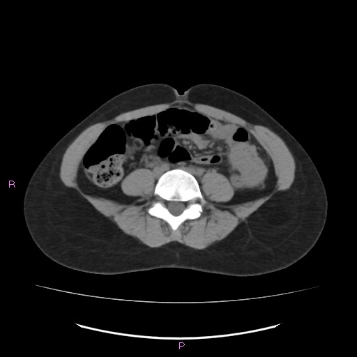 Acute pancreatitis secondary to stone at minor papilla and pancreatic divisum (Radiopaedia 76570-88333 Axial non-contrast 46).jpg