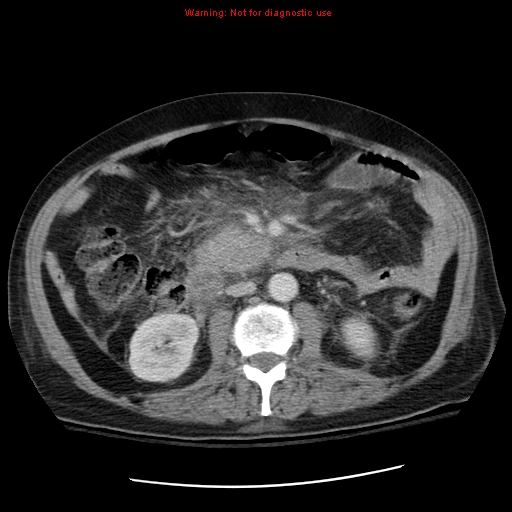 File:Acute pancreatitis with incidental pancreatic lipoma (Radiopaedia 10190-10730 Axial C+ portal venous phase 34).jpg