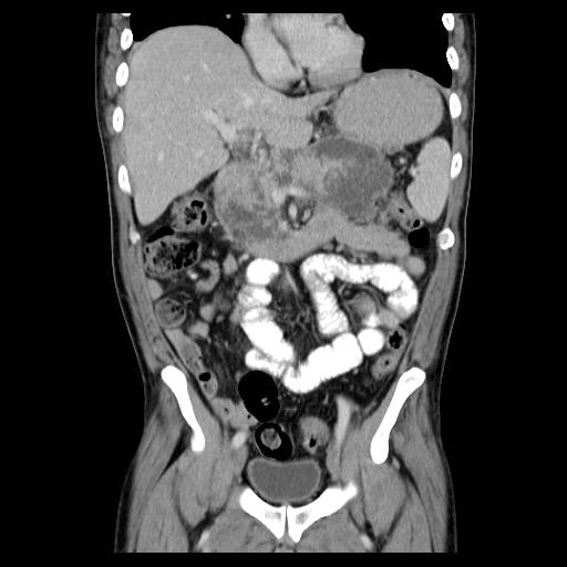 File:Acute pancreatitis with walled off pancreatic necrosis (Radiopaedia 6438-7797 Coronal C+ portal venous phase 3).jpg