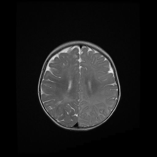 File:Acute phase of hemiconvulsion-hemiplegia epilepsy syndrome (Radiopaedia 29309-29745 Axial T2 8).jpg