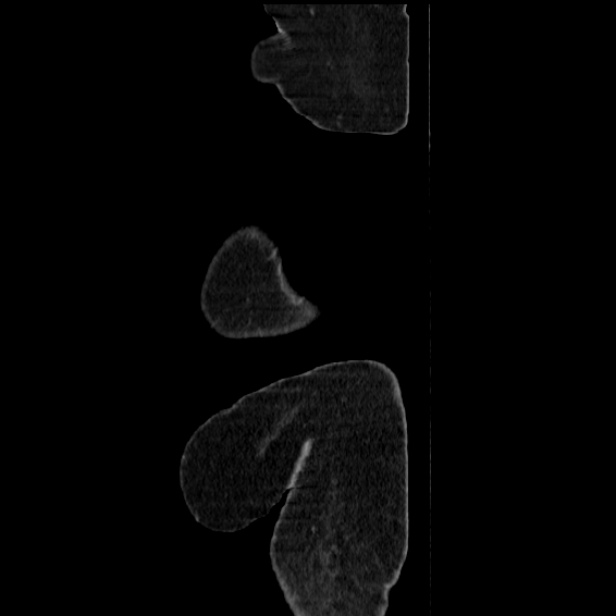 Acute pyelonephritis (Radiopaedia 25657-25837 Sagittal renal parenchymal phase 5).jpg