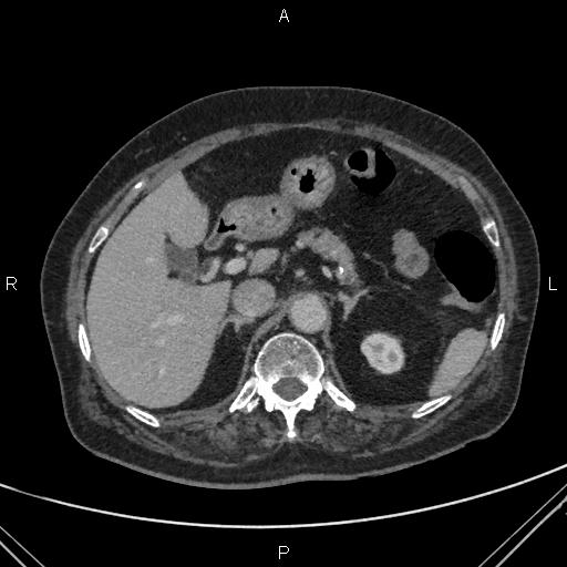 Acute renal artery occlusion (Radiopaedia 86586-102682 Axial C+ portal venous phase 18).jpg