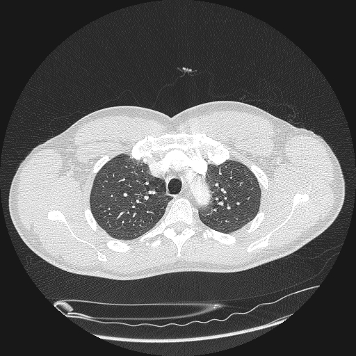 File:Acute segmental pulmonary emboli and pulmonary infarction (Radiopaedia 62264-70444 Axial lung window 40).jpg