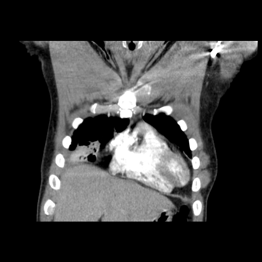 Acute segmental pulmonary emboli and pulmonary infarction (Radiopaedia 62264-70444 Coronal C+ CTPA 5).jpg