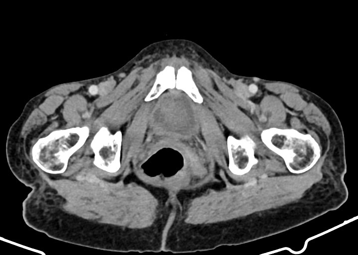 Acute small bowel (ileal) volvulus (Radiopaedia 71740-82139 Axial C+ portal venous phase 197).jpg