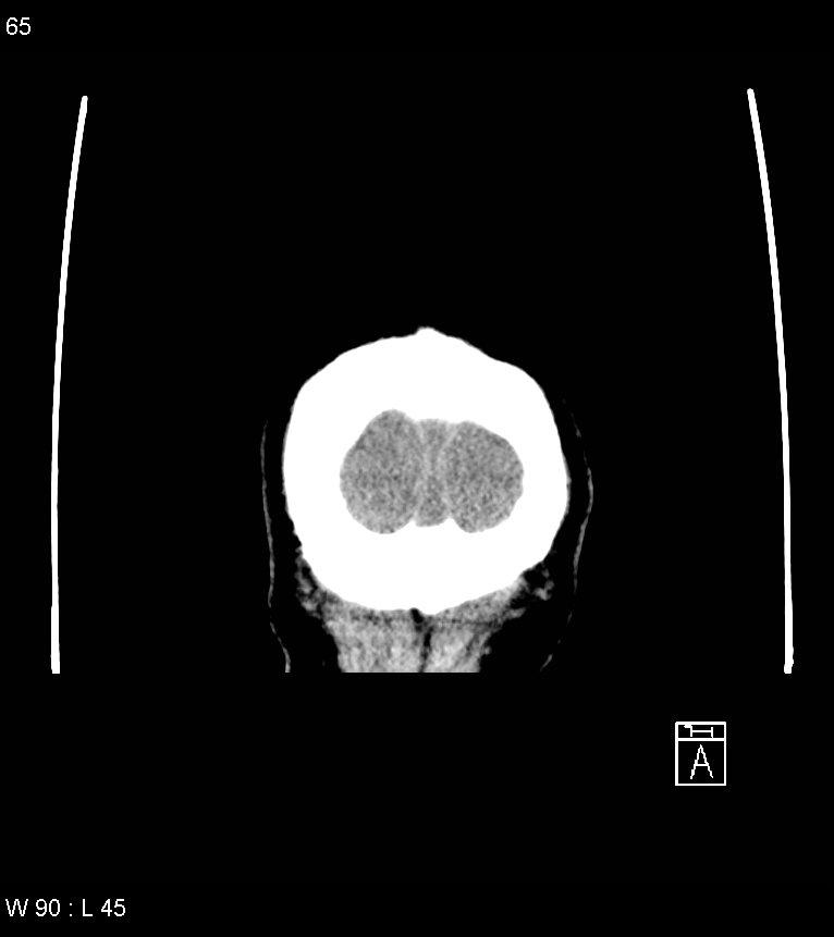 Acute subdural hematoma with myelofibrosis (Radiopaedia 52582-58494 Coronal non-contrast 56).jpg