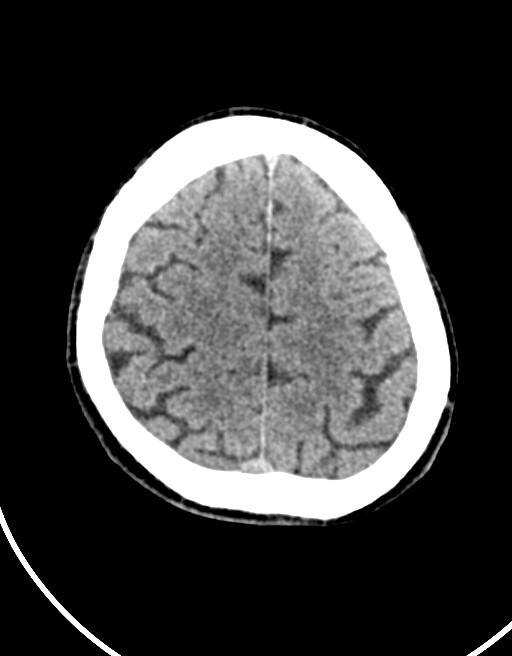 Acute superior cerebellar artery territory infarct (Radiopaedia 84104-99359 Axial non-contrast 19).jpg