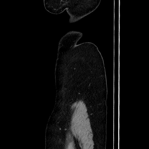File:Acute uncomplicated appendicitis (Radiopaedia 73704-84499 Sagittal C+ portal venous phase 35).jpg