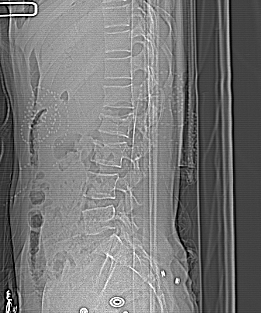 File:Acute vertebral compression fracture (Radiopaedia 63832-72559 A 1).jpg