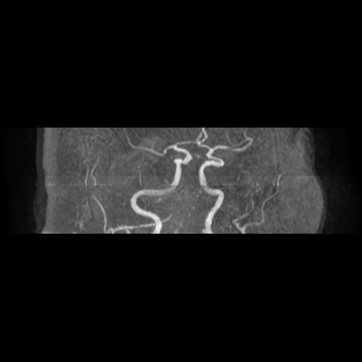Acute vertebrobasilar ischemic infarction (Radiopaedia 25220-25474 Axial MRA 15).jpg