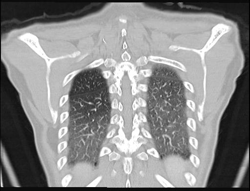 File:Addison disease (Radiopaedia 49318-54412 Coronal lung window 5).jpg