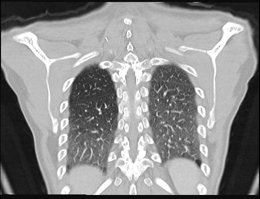 File:Addison disease (Radiopaedia 49318-54412 Coronal lung window 6).jpg