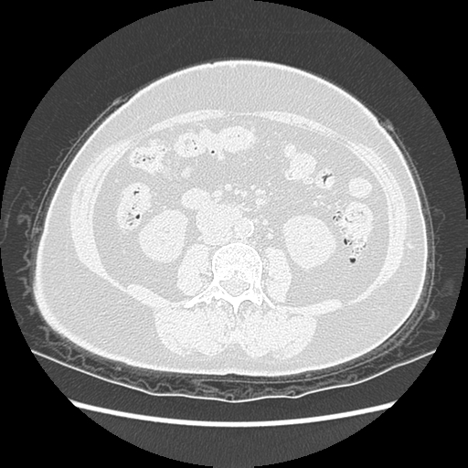 Adenocarcinoma in situ of lung (Radiopaedia 38685-40829 B 286).png