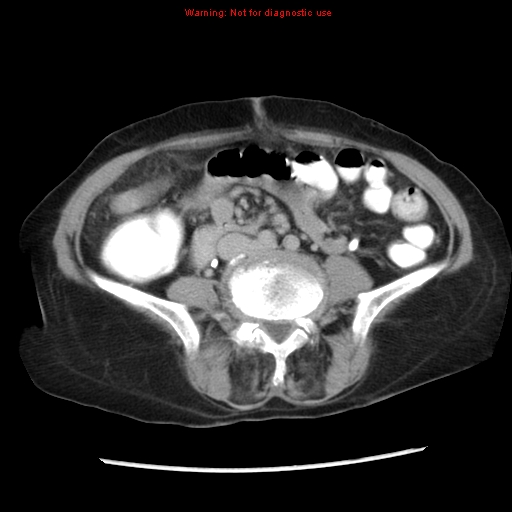 Adenocarcinoma of the colon (Radiopaedia 8191-9039 Axial renal excretory phase 32).jpg