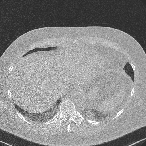 Adenoid cystic carcinoma of the trachea (Radiopaedia 49042-54137 Axial lung window 289).jpg
