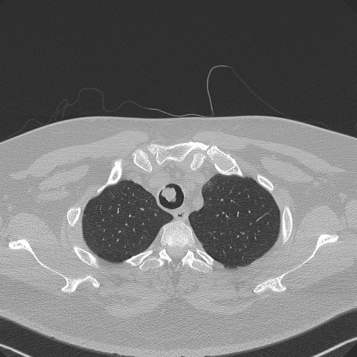 Adenoid cystic carcinoma of the trachea (Radiopaedia 49042-54137 Axial lung window 55).jpg