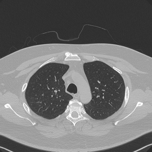 File:Adenoid cystic carcinoma of the trachea (Radiopaedia 49042-54137 Axial lung window 93).jpg