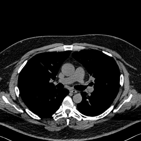 File:Adenoid cystic carcinoma of the trachea (Radiopaedia 49042-54137 Axial non-contrast 148).jpg