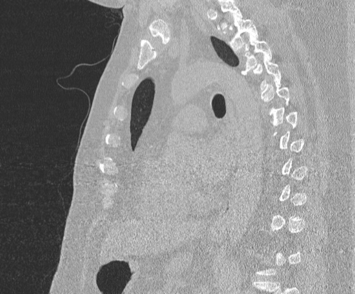 Adenoid cystic carcinoma of the trachea (Radiopaedia 49042-54137 Sagittal lung window 263).jpg