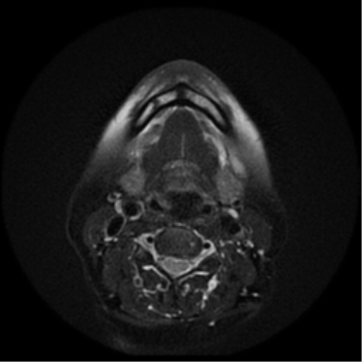 File:Adenoid cystic tumor of palate (Radiopaedia 46980-51519 Axial T2 10).png