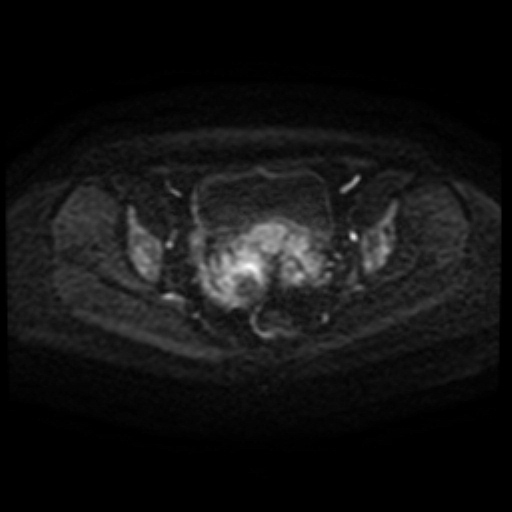 Adenoma malignum of cervix (Radiopaedia 66441-75705 Axial DWI 88).jpg