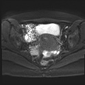 File:Adenomyosis and endometriotic cysts (Radiopaedia 82300-96367 Axial DWI 8).jpg