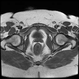 File:Adenomyosis within a didelphys uterus (Radiopaedia 70175-80215 Axial T1 34).jpg