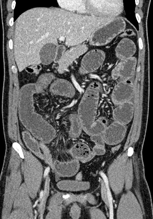 Adhesional small bowel obstruction (Radiopaedia 58900-66131 Coronal C+ portal venous phase 116).jpg