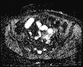 File:Adnexal multilocular cyst (O-RADS US 3. O-RADS MRI 3) (Radiopaedia 87426-103754 Axial 171).jpeg