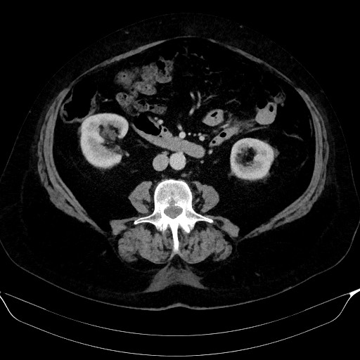 Adrenal cortical carcinoma (Radiopaedia 64017-72769 Axial C+ portal venous phase 36).jpg