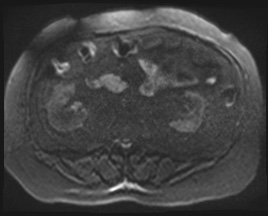File:Adrenal cortical carcinoma (Radiopaedia 64017-72770 Axial DWI 112).jpg