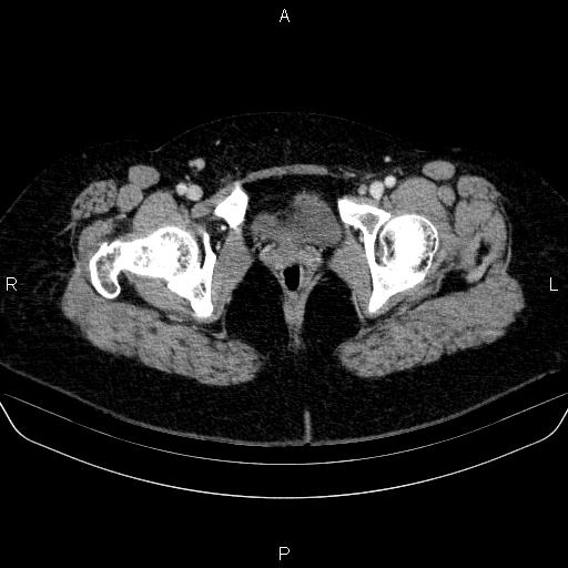 Adrenal cortical carcinoma (Radiopaedia 84882-100379 Axial C+ portal venous phase 95).jpg