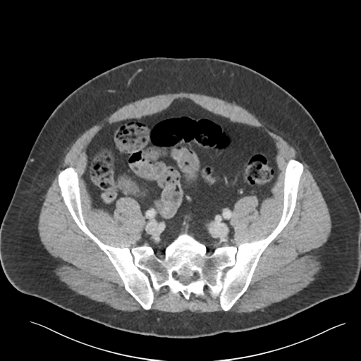 Adrenal cyst (Radiopaedia 45625-49777 Axial C+ portal venous phase 77).png