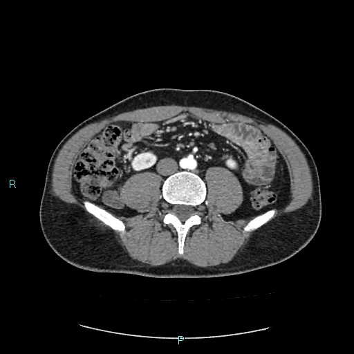 Adrenal cystic lymphangioma (Radiopaedia 83161-97534 Axial C+ arterial phase 58).jpg