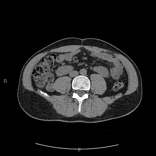 Adrenal cystic lymphangioma (Radiopaedia 83161-97534 Axial non-contrast 57).jpg