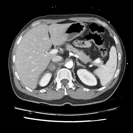File:Adrenal gland trauma (Radiopaedia 81351-95078 Axial Dual bolus trauma C+ 63).jpg