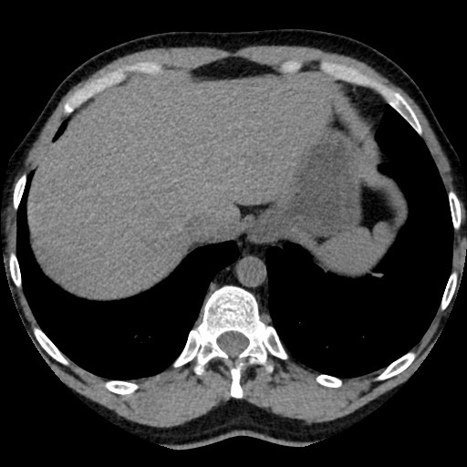 Adrenal gland trauma (Radiopaedia 81351-95079 Axial non-contrast 16).jpg