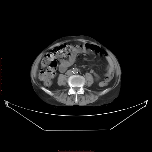 File:Adrenal hemangioma (Radiopaedia 68923-78668 Axial non-contrast 43).jpg