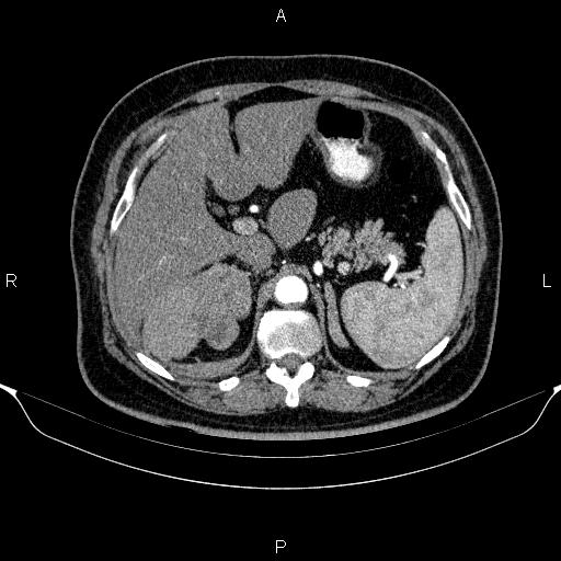 Adrenal hemorrhage (Radiopaedia 62622-70916 Axial C+ arterial phase 99).jpg