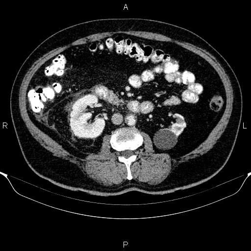 Adrenal hemorrhage (Radiopaedia 62622-70916 Axial C+ portal venous phase 90).jpg
