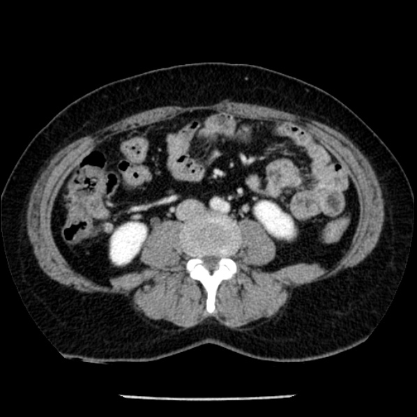File:Adrenal myelolipoma (Radiopaedia 43401-46759 Axial C+ portal venous phase 48).jpg