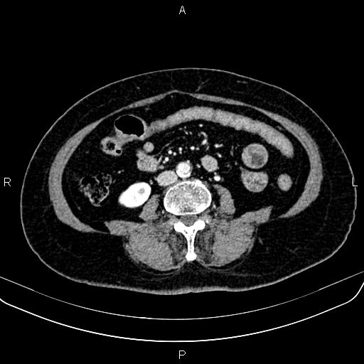 Adrenal myelolipoma (Radiopaedia 82742-96986 Axial renal cortical phase 101).jpg